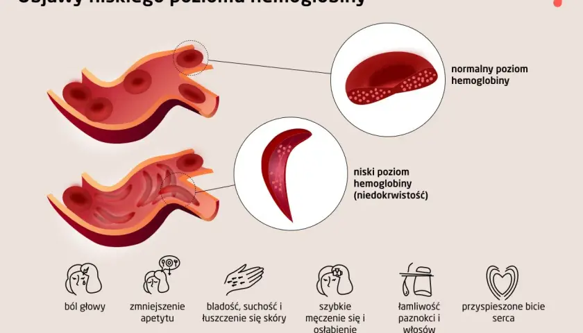 Niski poziom hemoglobiny (niedokrwistość) objawia się bólem głowy, bladością, łamliwością paznokci i przyspieszonym biciem serca.