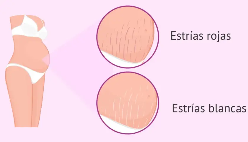 Ilustración de abdomen de embarazada mostrando estrías rojas y blancas, marcas comunes del embarazo.