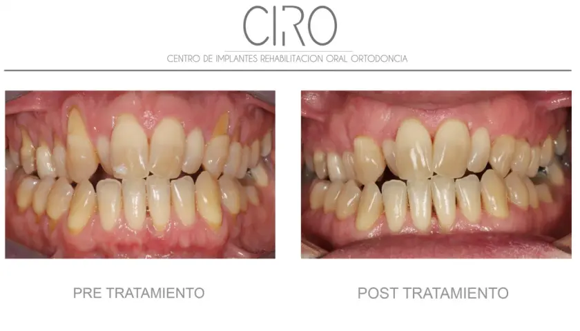 Comparación antes y después de un tratamiento de mantenimiento periodontal. Dientes amarillentos y encías inflamadas antes, y dientes limpios y encías sanas después.