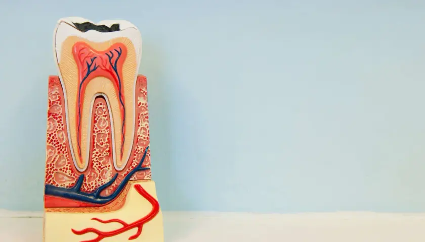 Modelo dental muestra caries profunda, exponiendo la pulpa dental. Se aprecian nervios y vasos sanguíneos.
