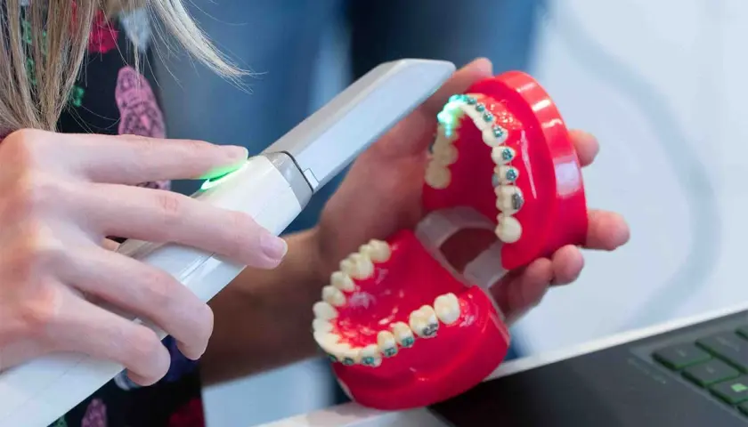 Cyfrowy wycisk zębów cena: nowoczesna technologia w stomatologii. Skaner 3D tworzy precyzyjny model szczęki z aparatem ortodontycznym.