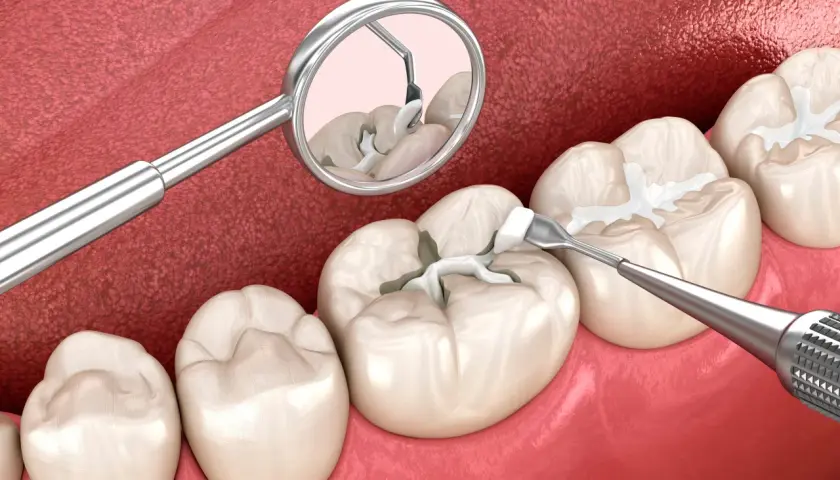 Un dentista aplica selladores dentales para proteger las muelas de las caries.