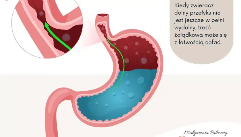 Ilustracja pokazuje cofanie się treści żołądkowej do przełyku, co jest typowe dla refluksu u niemowlaka.