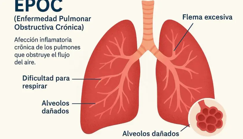 Ilustración de pulmones con EPOC, mostrando flema excesiva, dificultad para respirar y alvéolos dañados, una sensación de frío en los pulmones.