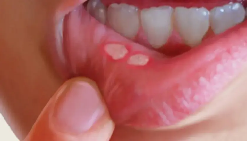 Afta a dentysta: Przełożyć wizytę czy iść? Jasne wskazówki.