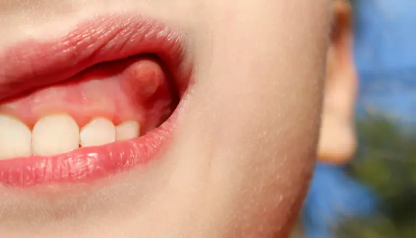 Primer plano de una boca infantil mostrando un bulto en la encía, cerca de los dientes frontales.