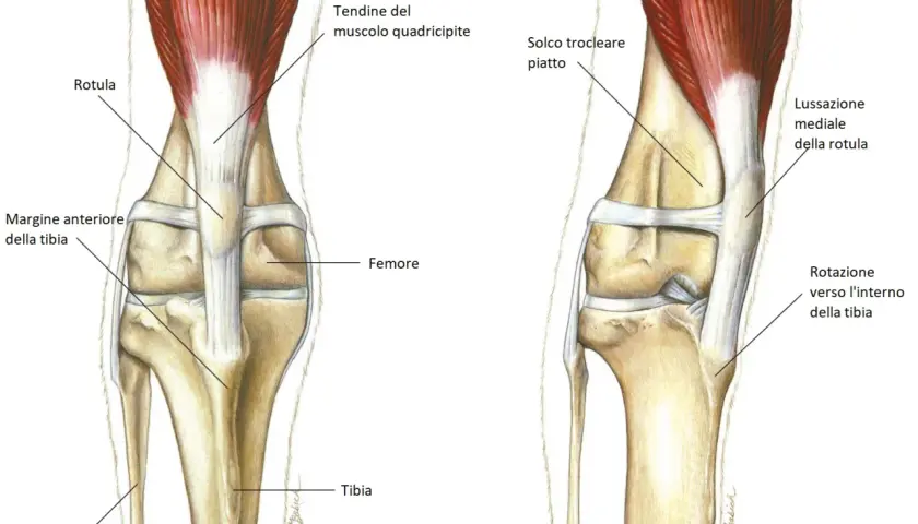 Illustrazione anatomica del ginocchio di un cane, che mostra la rotula in posizione normale e una lussazione mediale della rotula, con rotazione interna della tibia.