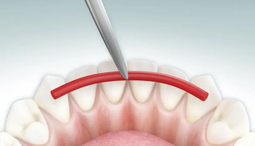 Strumento dentale applica filo rosso per splintaggio denti inferiori, facilitando la pulizia.