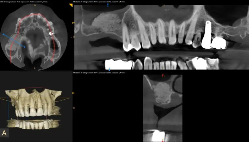 Immagini TC dentali che mostrano un rialzo seno mascellare prima e dopo, con innesto osseo e impianto dentale.