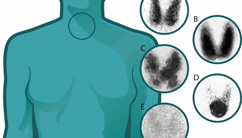 Imágenes de gammagrafía tiroidea que muestran la función de la glándula tiroides. El yodo para que sirve es fundamental para la producción de hormonas tiroideas.