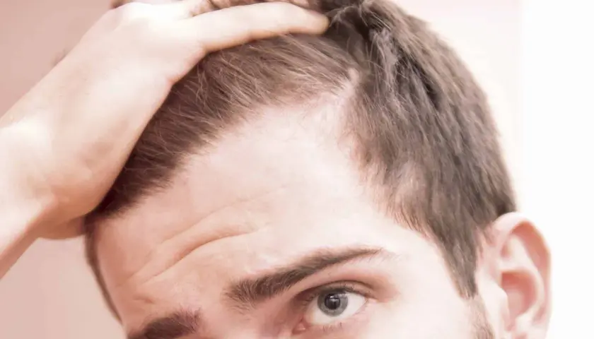 Hombre preocupado por el efluvio telógeno, tocando su cabeza. Considera usar minoxidil para recuperar su cabello.