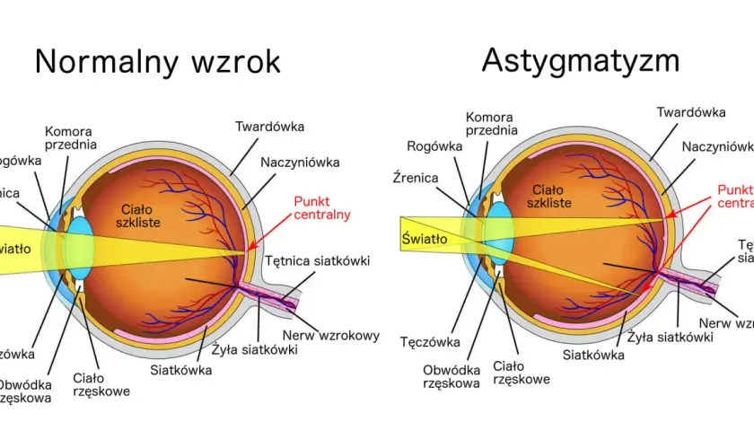 Porównanie oka z astygmatyzmem i normalnym wzrokiem. Astygmatyzm objawy: światło rozprasza się na siatkówce, zamiast skupiać w jednym punkcie.