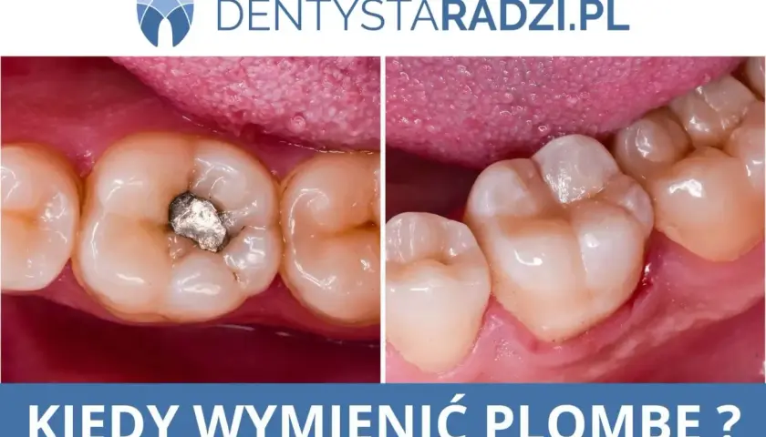 Porównanie zęba z amalgamatową plombą tymczasową i po jej wymianie na nową, estetyczną.
