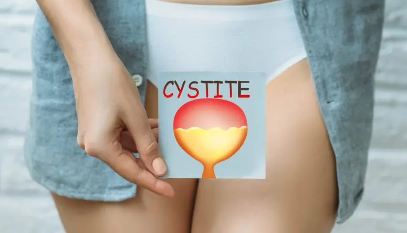 Une main tient une carte illustrant une vessie enflammée, avec le mot "CYSTITE" écrit en rouge. Cela peut aider à comprendre comment attraper une infection urinaire.