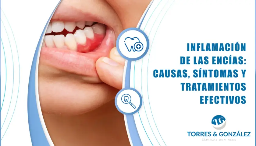 Primer plano de encías inflamadas, mostrando los síntomas de la gingivitis. Información sobre causas y tratamientos.