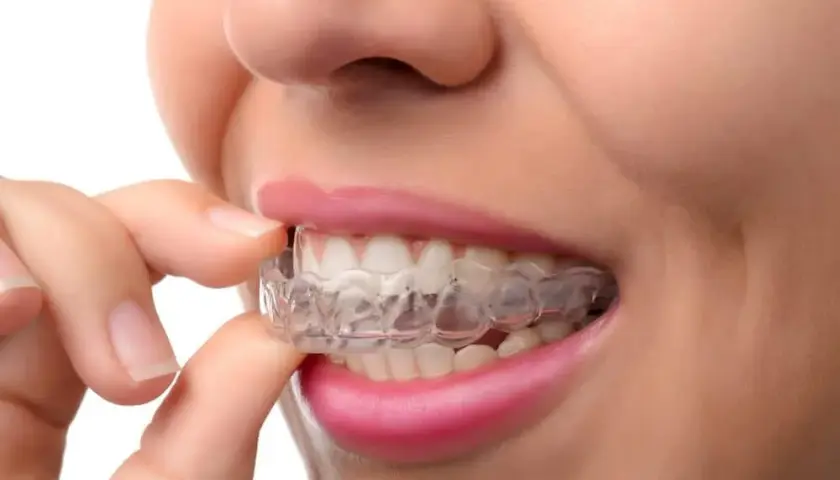 Ile kosztuje przezroczysty aparat na zęby? Sprawdź ceny i opcje leczenia