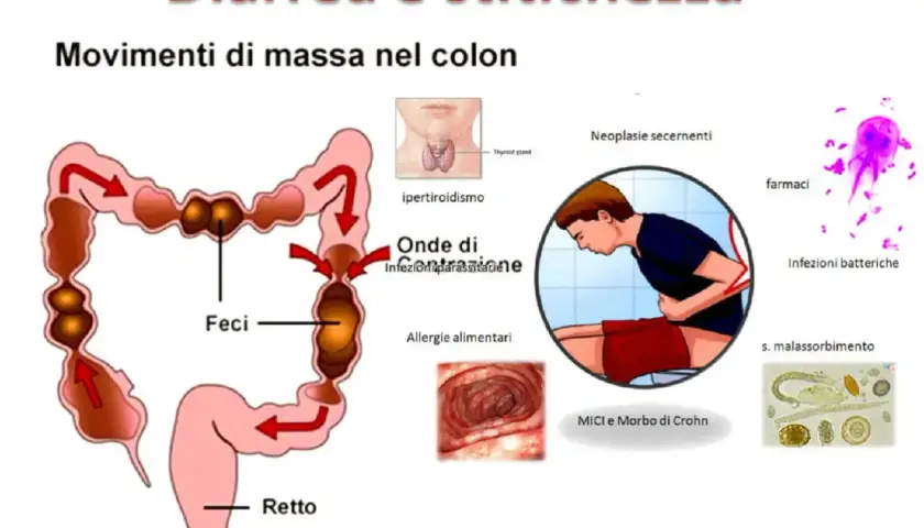 Diarrea e stitichezza: cause e rimedi. Immagine mostra colon, feci, retto, ipertiroidismo, infezioni, allergie, farmaci, malassorbimento.