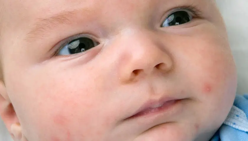 Primo piano del viso di un neonato con lievi arrossamenti e qualche piccolo brufolo, tipici dell'acne neonatale.