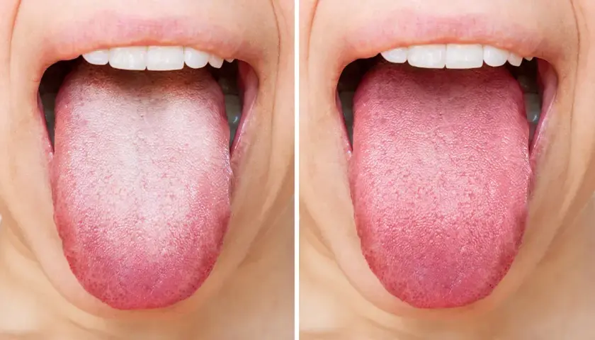 Comparación de lenguas: una muestra la suciedad en la lengua, la otra muestra una lengua limpia y rosada.
