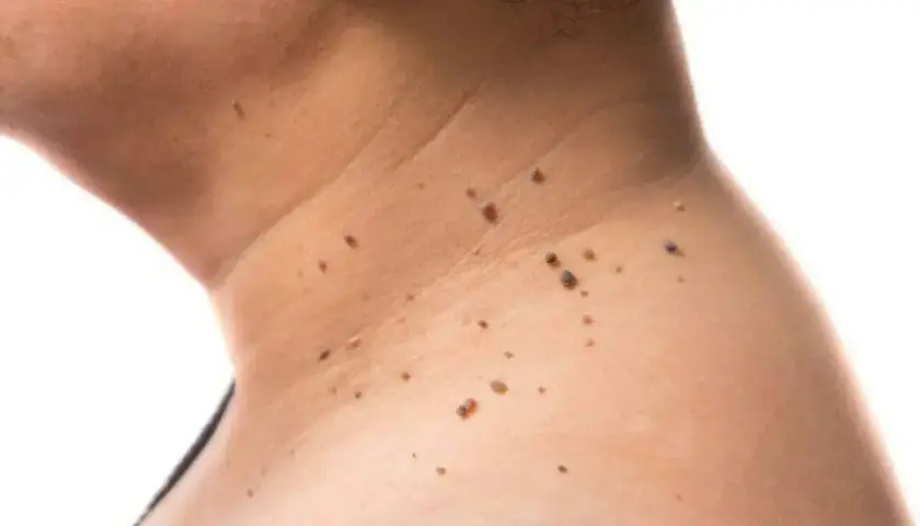 Primer plano de la piel del cuello mostrando varios tipos de manchas, incluyendo lunares y verrugas.