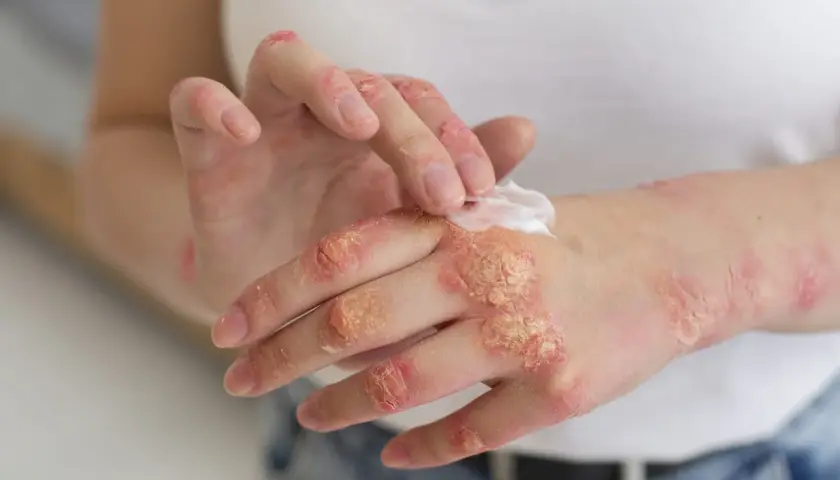 Manos con psoriasis, aplicando crema para aliviar la piel seca y escamosa.