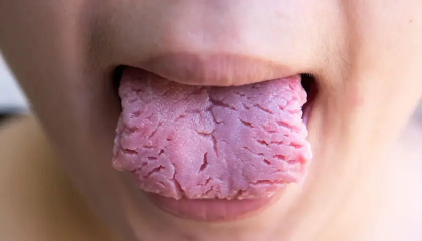 Primer plano de una lengua roja con surcos profundos, asomando entre los labios.