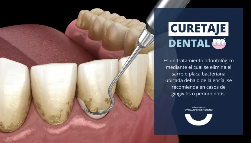 Instrumento dental elimina sarro bajo la encía, esencial para la limpieza periodontal y prevenir la periodontitis.