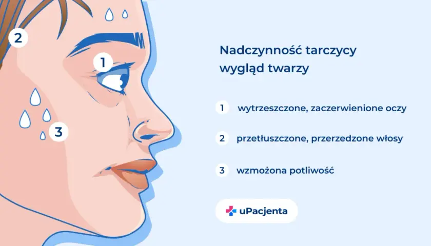 Nadczynność tarczycy objawia się wytrzeszczem oczu (1), przetłuszczonymi włosami (2) i wzmożoną potliwością (3).