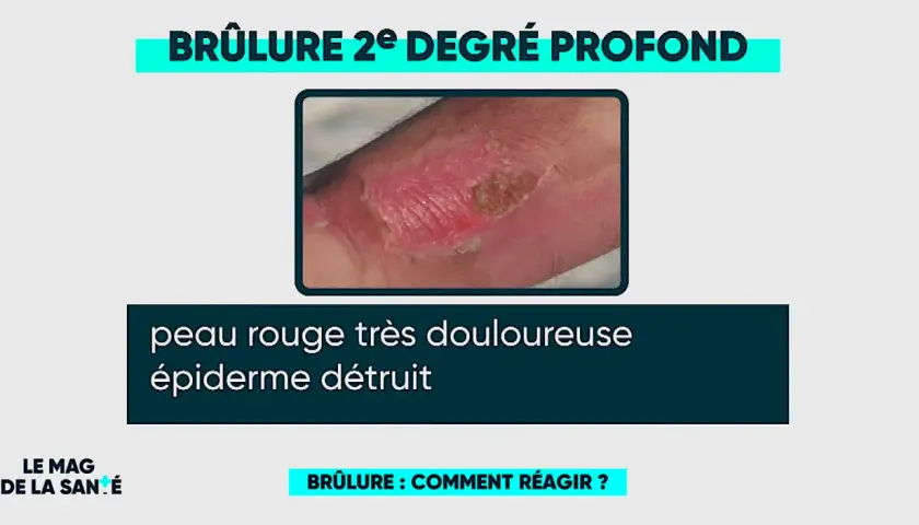 Brûlure 2e degré profond sur la main, peau rouge et douloureuse, épiderme détruit. Une brûlure eau bouillante degré.