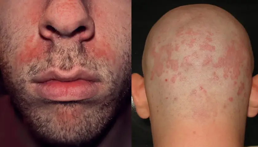 Viso e cuoio capelluto con arrossamenti e squame, segni tipici della dermatite seborroica.
