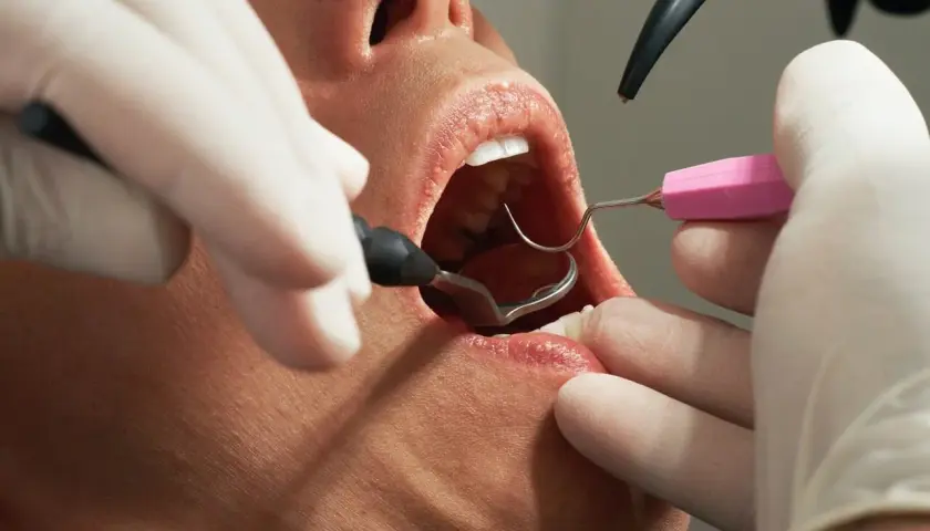 Zabieg ekstrakcji zęba przy stanie zapalnym. Dentysta w rękawiczkach używa narzędzi do usunięcia zęba.