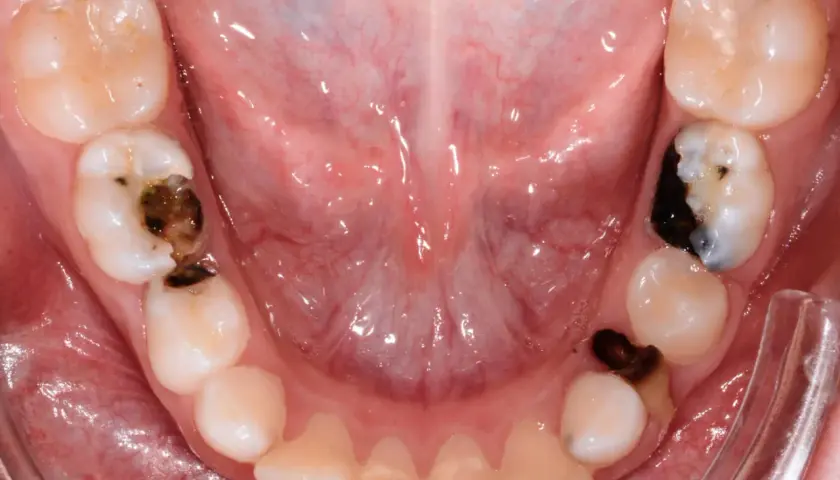 Denti da latte con carie evidenti, alcuni con otturazioni scure.
