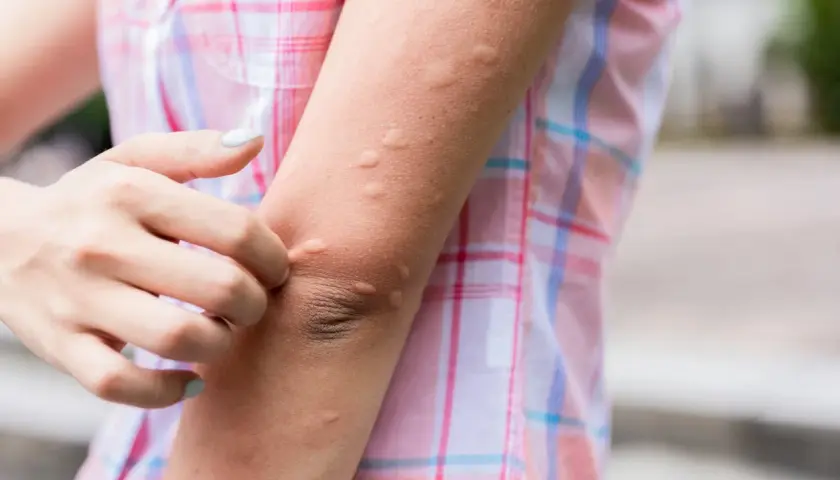 Brazo con ronchas rojas y elevadas, una mano se rasca la piel.