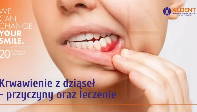 Jak zatamować krwotok z dziąsła? Szybkie sposoby i przyczyny