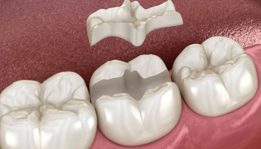 Una incrustación cerámica dental lista para ser colocada en un molar.