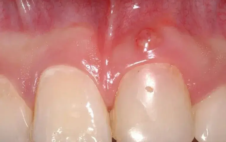 Zapalenie dziąseł u dziecka: Szybka ulga i kiedy do dentysty?