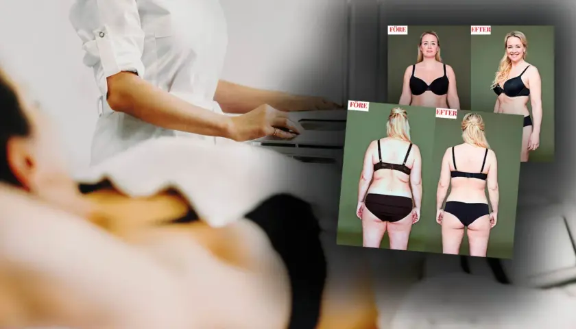 Före- och efterbilder visar resultat av coolsculpting armar. En person i vit rock utför behandling.