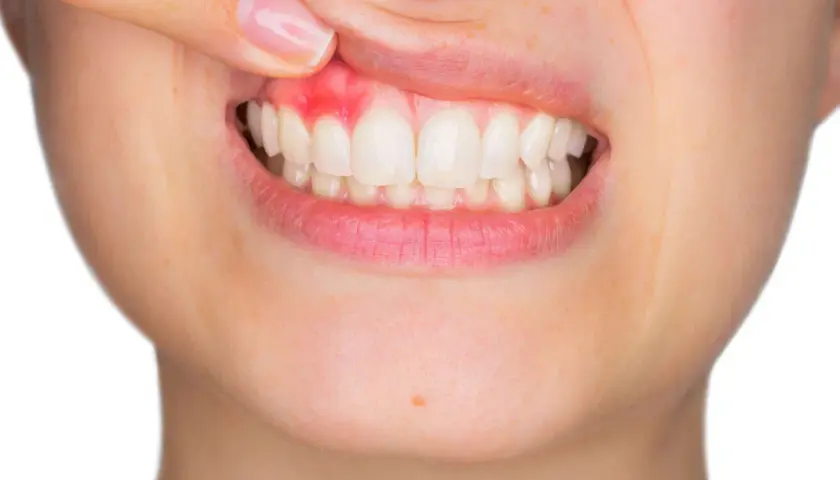 Dente con gengiva arrossata e gonfia, uno dei parodontite sintomi.