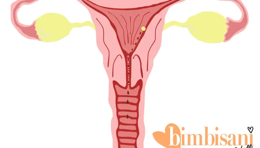 Utero con ovidotti e ovaie. Piccole macchie marroni indicano possibili perdite da impianto.