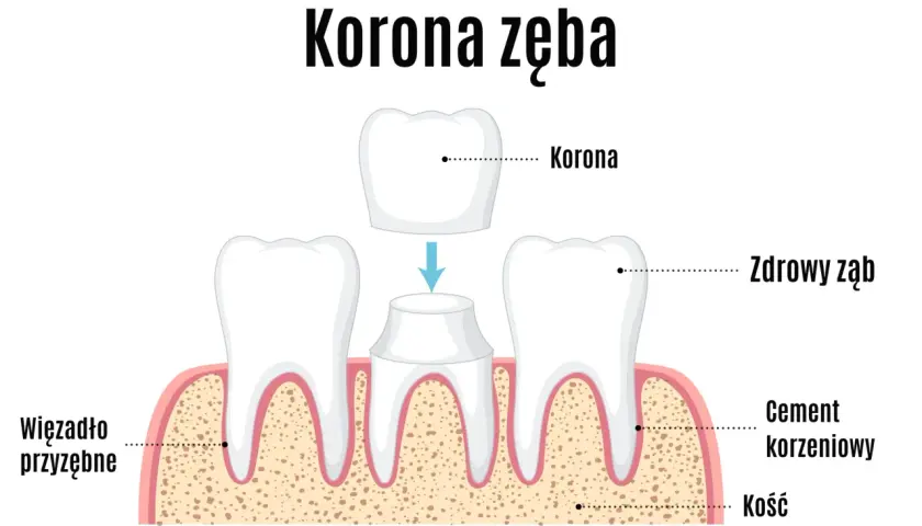 Ilustracja pokazuje proces zakładania korony na ząb. Zastanawiasz się, ile kosztuje koronka na jednego zęba?