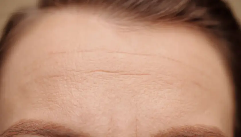 Close-up of a forehead with visible horizontal wrinkles and eyebrows.