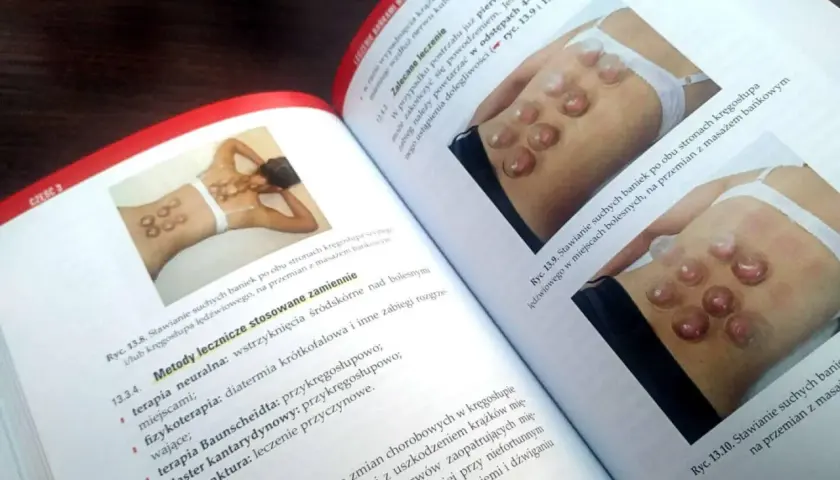 Książka omawia techniki stawiania baniek na plecach, ilustrując je na przykładach.
