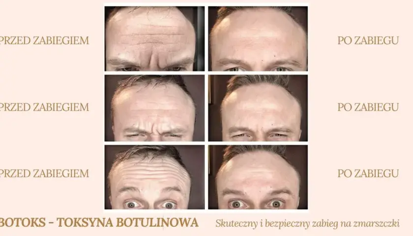Jak działa botoks? Mechanizm, efekty i bezpieczny zabieg