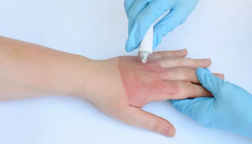 Application d'une crème sur une brûlure à l'eau bouillante. La guérison d'une brûlure eau bouillante combien de temps dépend de sa gravité.