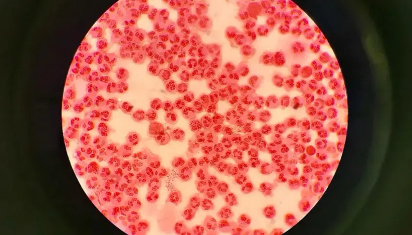Mikroskopowy obraz komórek zapalnych i bakterii Neisseria gonorrhoeae, które mogą powodować rzeżączkę na penisie.