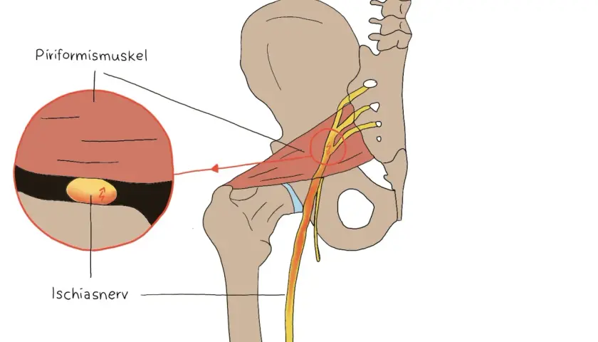 Illustration zeigt, wie der Ischiasnerv durch den Piriformis-Muskel komprimiert wird, was zu Schmerzen führt.