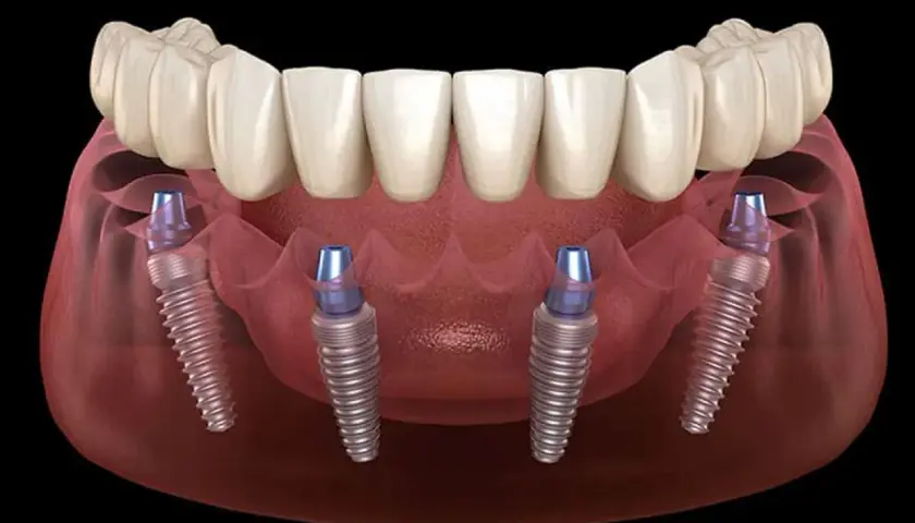 Immagine 3D di un'arcata dentale superiore con protesi fissa su quattro impianti, dimostrando la tecnica di implantologia all on four.