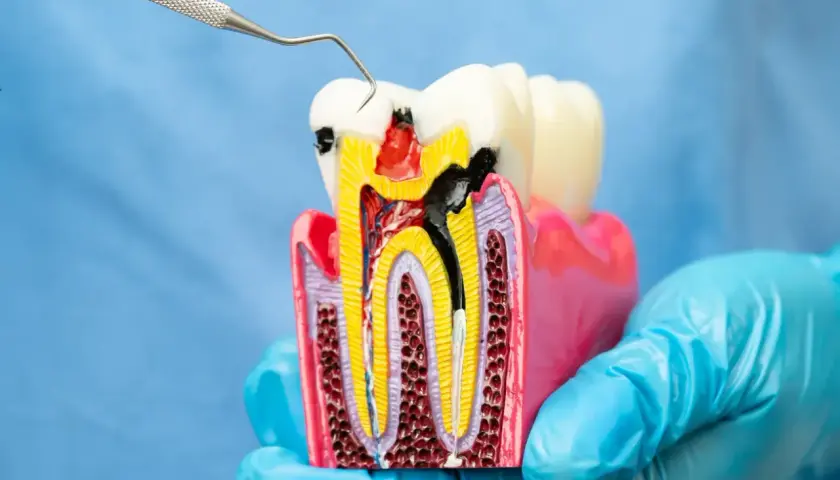 Model zęba z widocznym ubytkiem i narzędziem dentystycznym. Zastanawiasz się nad leczeniem kanałowym? Cena może być niższa niż myślisz.