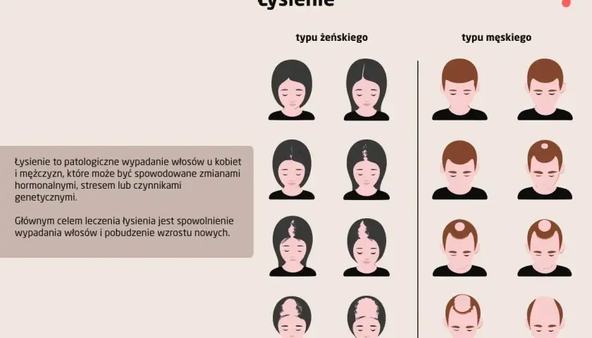 Ilustracja pokazuje różne etapy łysienia u kobiet i mężczyzn, w tym łysienie z tyłu głowy.