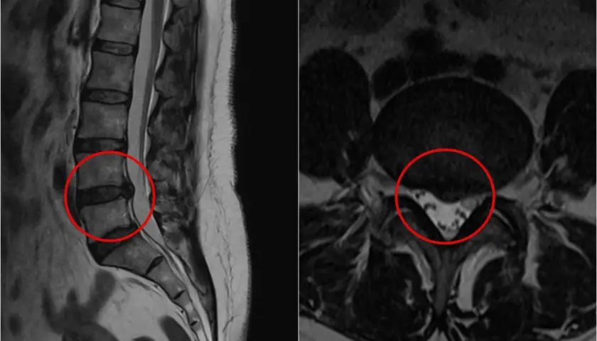 Widoczne na obrazach MRI kręgosłupa lędźwiowego zmiany wskazują na nieleczoną przepuklinę krążka międzykręgowego, uciskającą na struktury nerwowe.